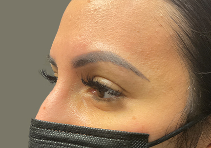 https://www.nwfacebody.com/wp-content/uploads/Botox-after-1.jpg