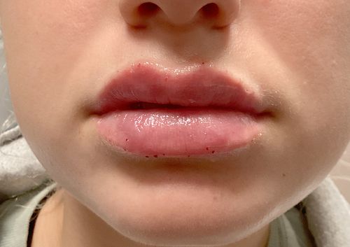 https://www.nwfacebody.com/wp-content/uploads/upper-Blephroplasty-aft-1.jpg